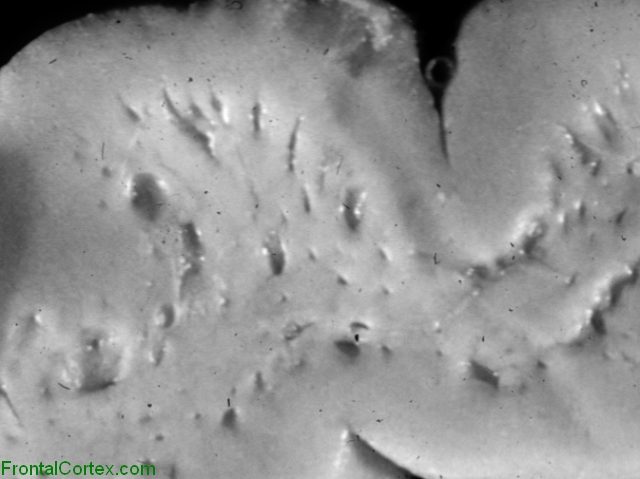 Etat Crible, close-up of cerebral cortex and white matter